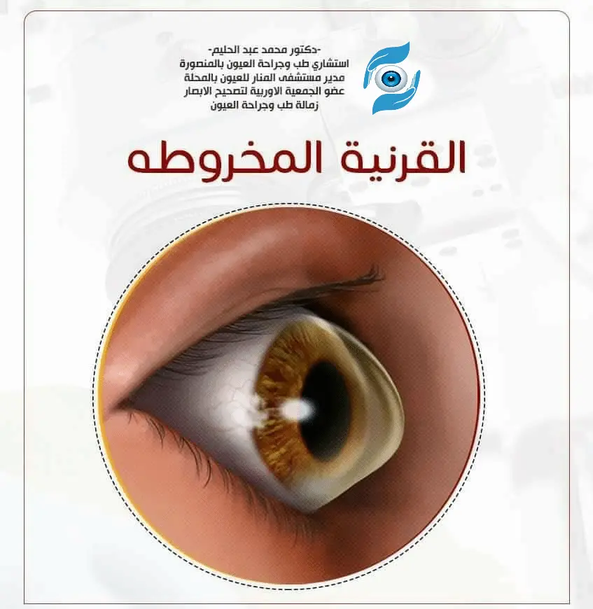  القرنية المخروطية 